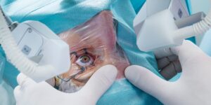 Best Preparation Tips for Cataract Eye Surgery